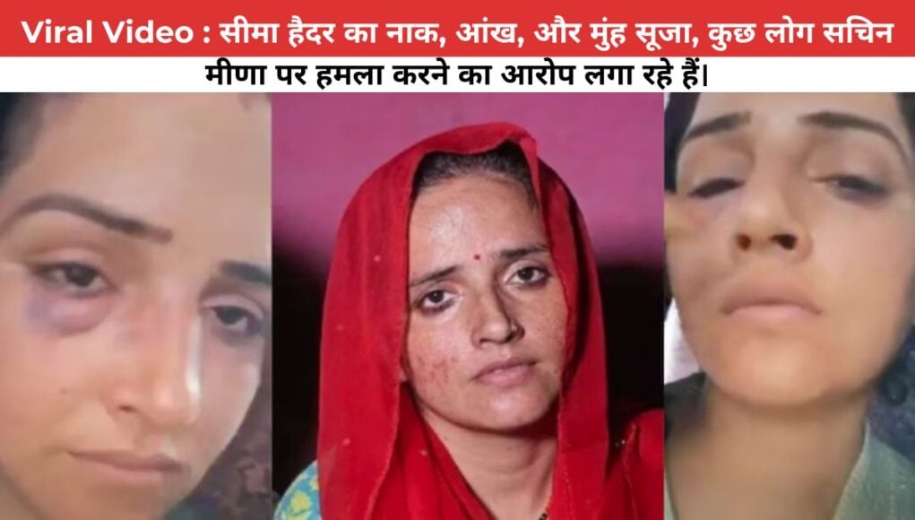 Viral Video : Seema Haider का नाक, आंख, और मुंह सूजा, कुछ लोग सचिन मीणा पर हमला करने का आरोप लगा रहे हैं।